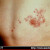 HERPES Y VACUNAS COVID HERPES Y VACUNAS COVID